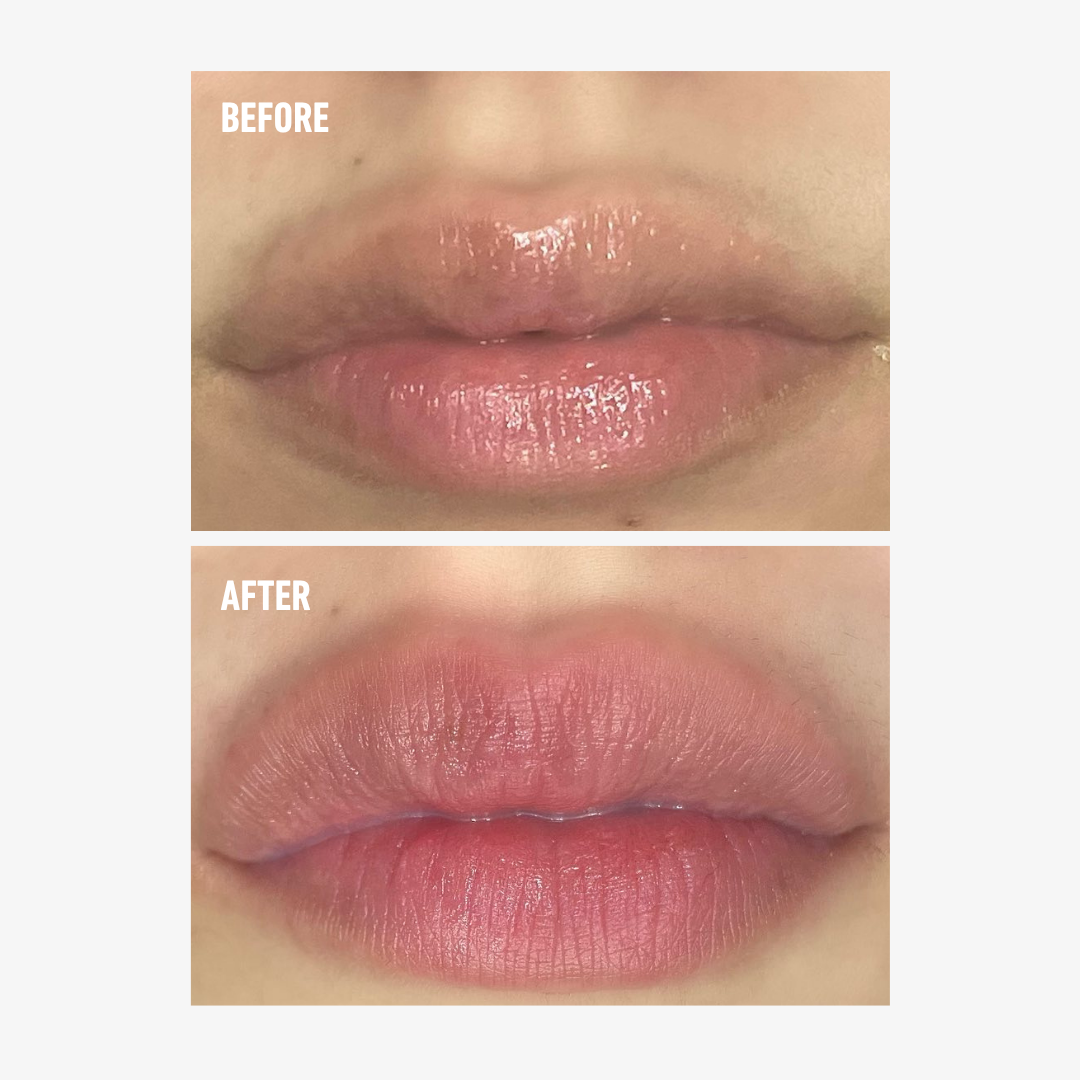 freezeframe LIP INJECTION before and after comparison showing a close-up of lips with visibly fuller-looking volume and a more defined appearance in the after image.