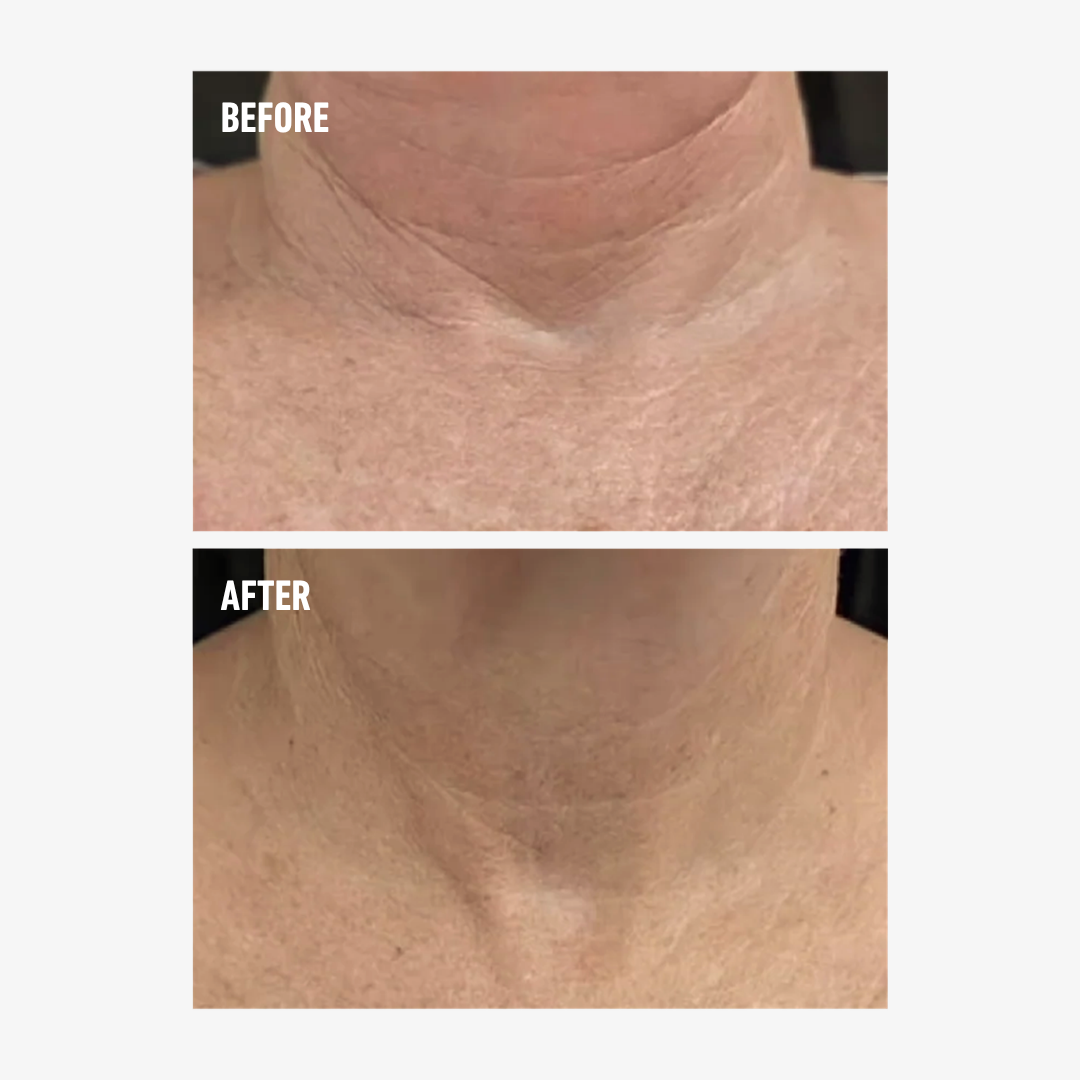 freezeframe NECK LIFT before and after comparison showing visibly smoother, firmer-looking neck and décolletage skin, with reduced appearance of deep horizontal neck wrinkles and fine lines.