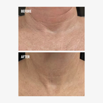 freezeframe NECK LIFT before and after comparison showing visibly smoother, firmer-looking neck and décolletage skin, with reduced appearance of deep horizontal neck wrinkles and fine lines.