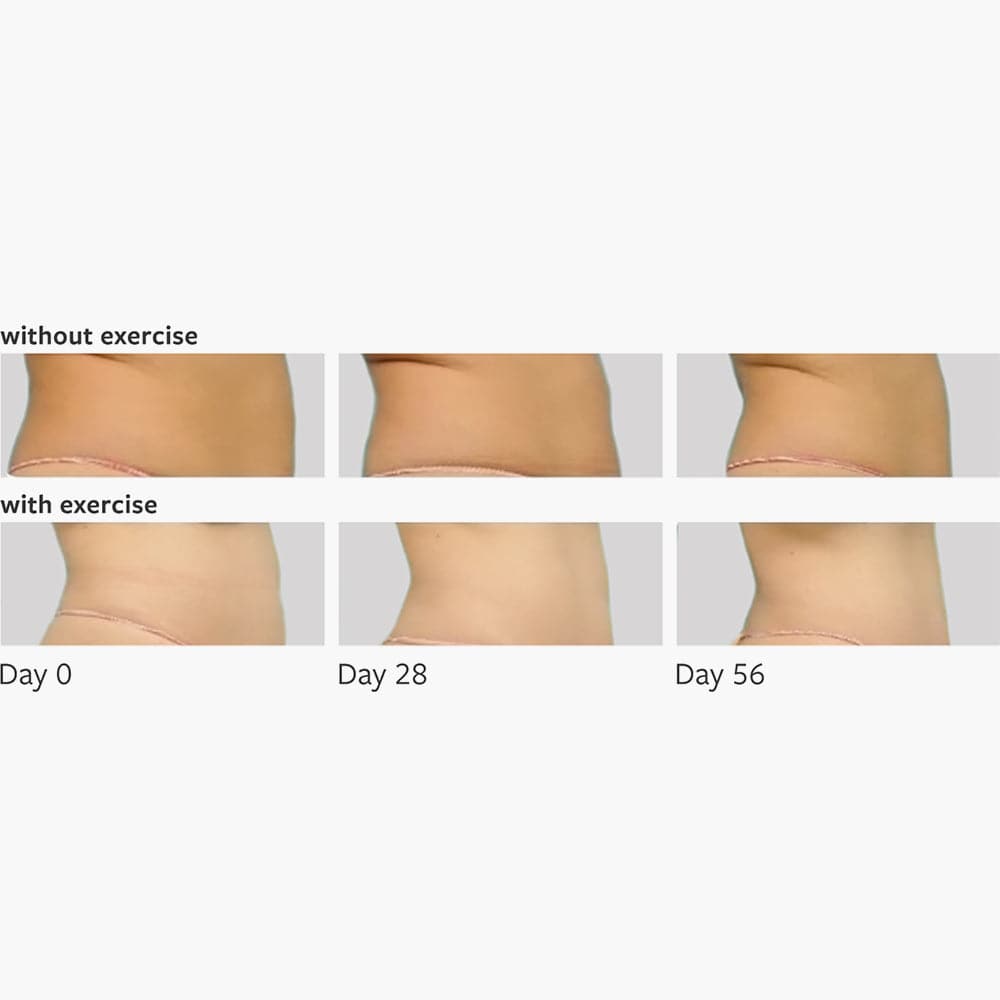 TUMMY TUCK - Freezeframe